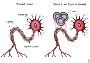 5 Early Signs Of Multiple Sclerosis - MS4MS